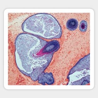 Dermoid ovarian cyst, light micrograph (C019/9256) Sticker